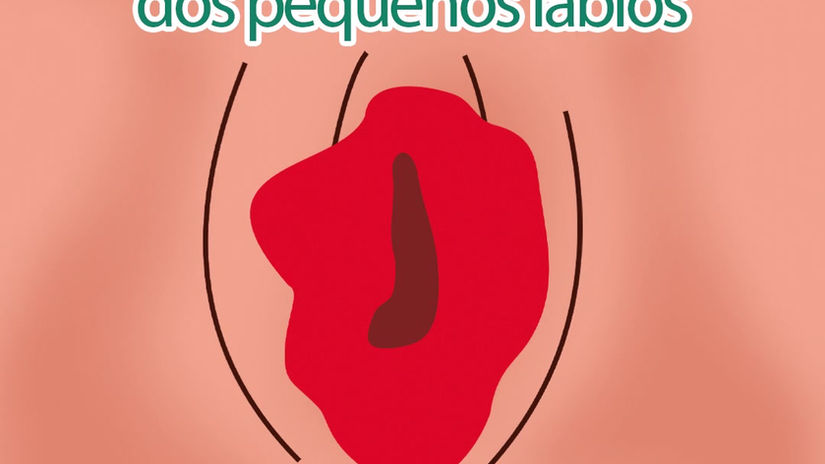 Hipertrofia dos pequenos lábios